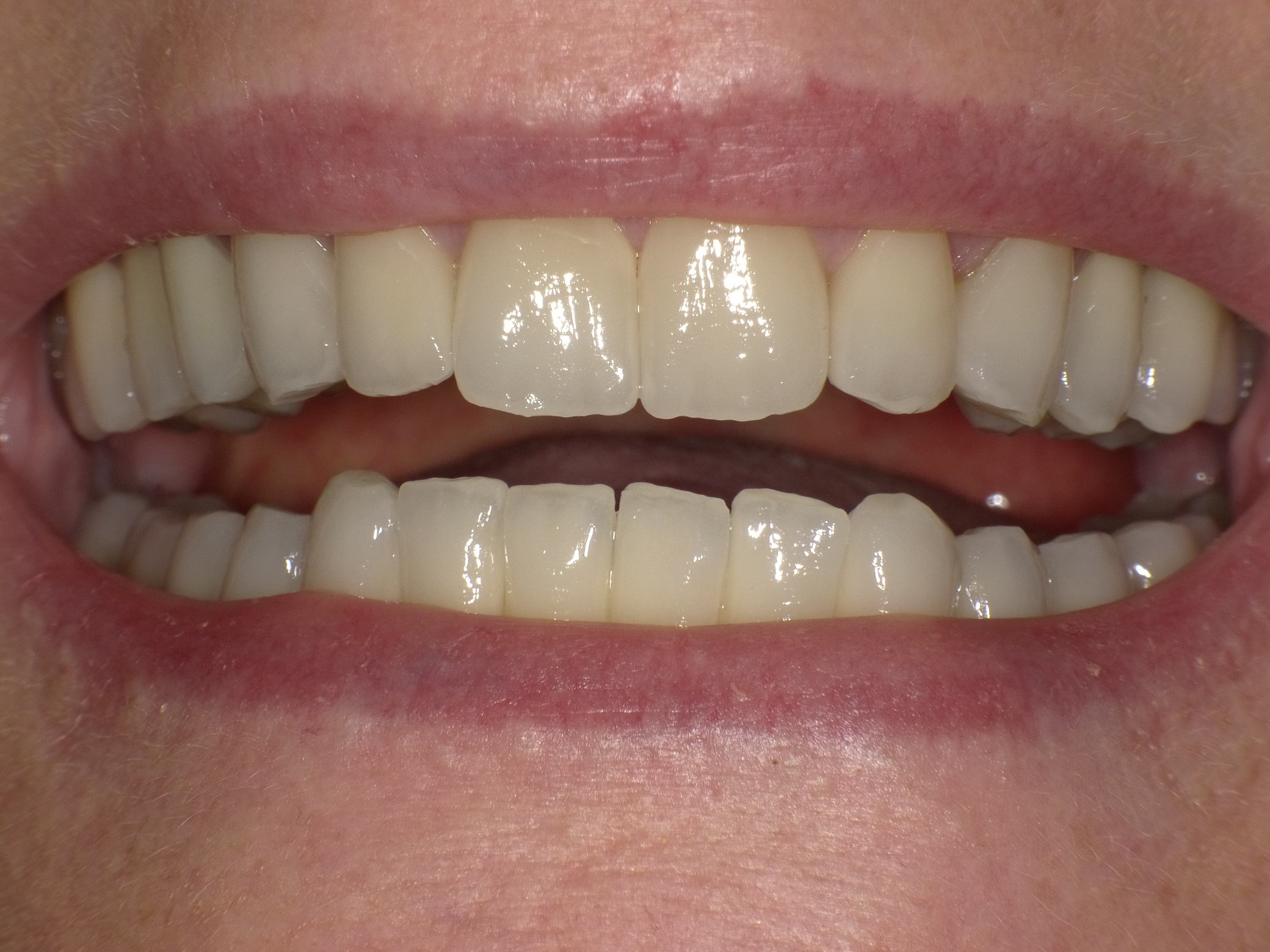 Gesamtbehandlung in wenigen Langzeitterminen mit keramischen Kronen, Veneers und Implantaten